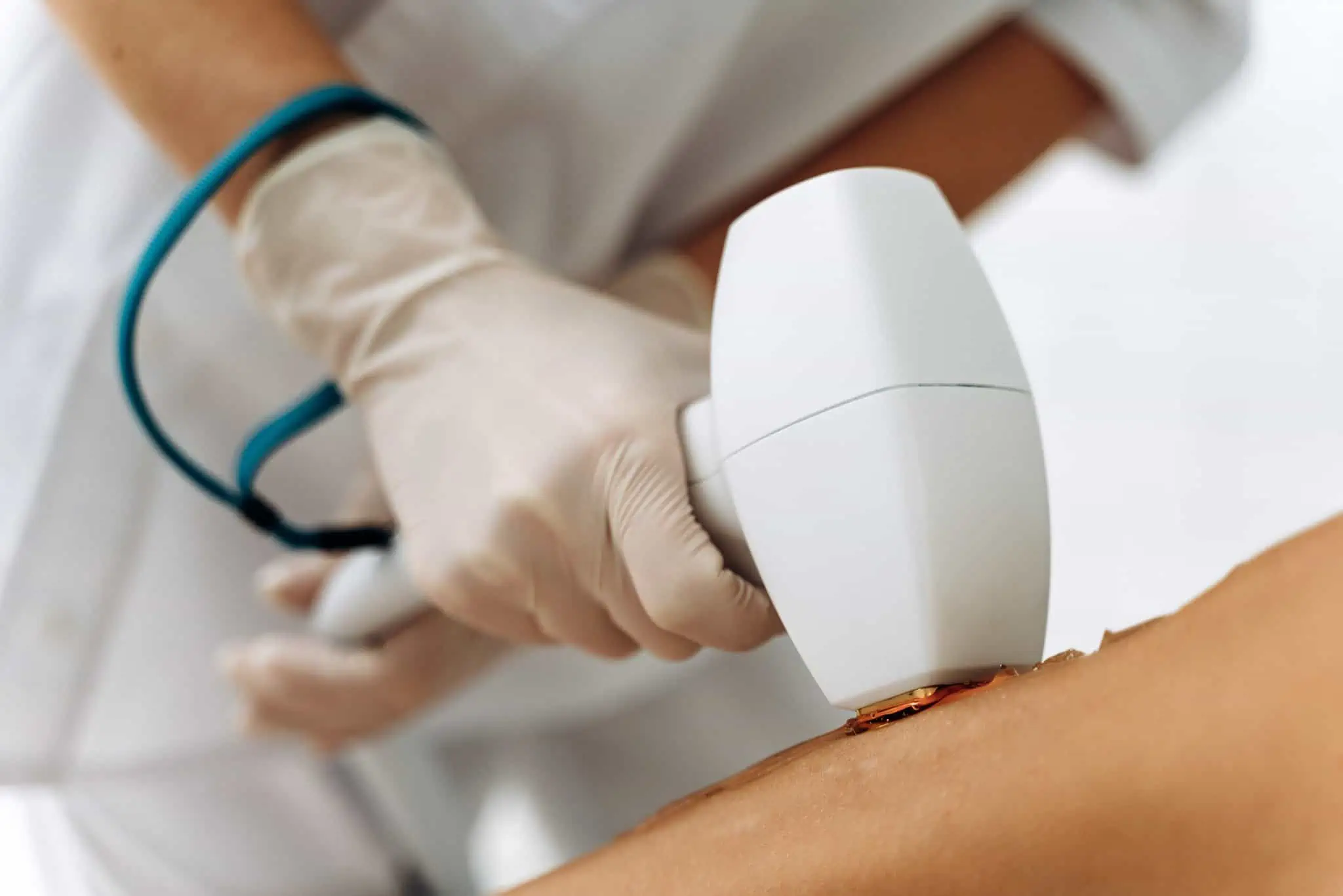 LASER HAIR REMOVAL